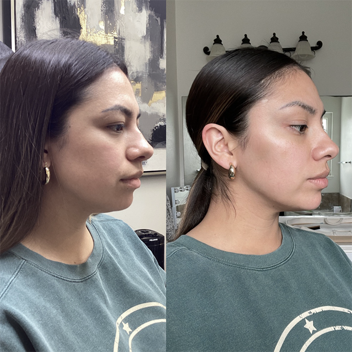 FACIAL BALANCING CHIN AND CHEEK