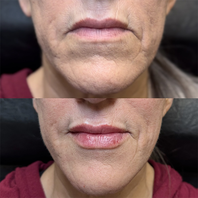 LOWER FACE FACIAL BALANCING