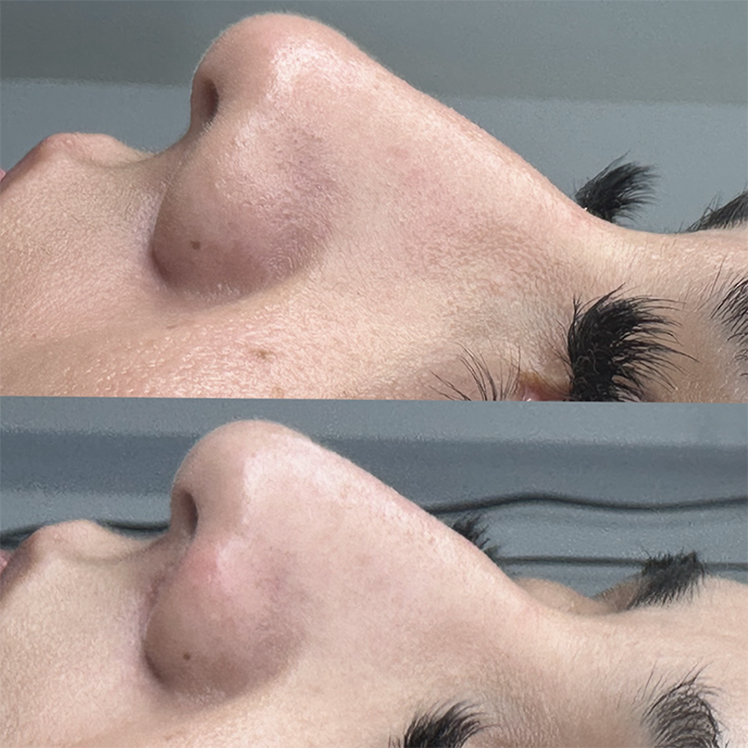 NON SURGICAL NOSE JOB