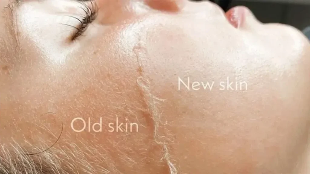 Dermaplaning in Houston