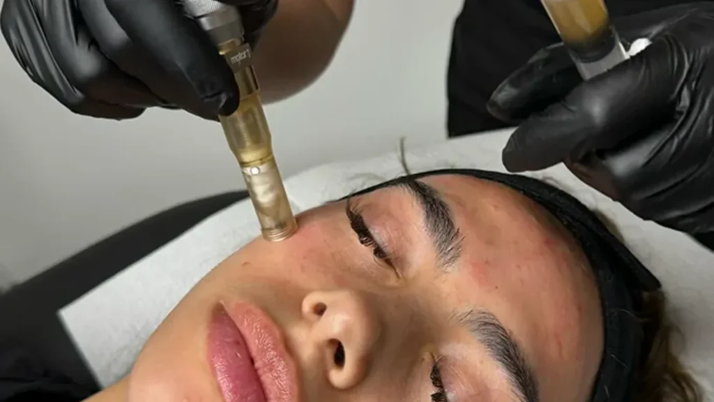 Microneedling in Houston