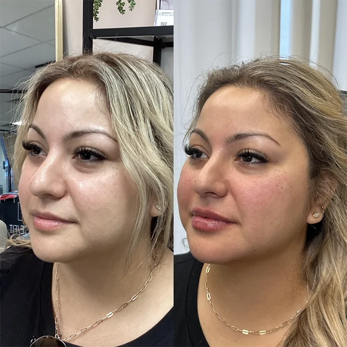 FACIAL BALANCING LIPS CHEEKS CHIN JAWLINE